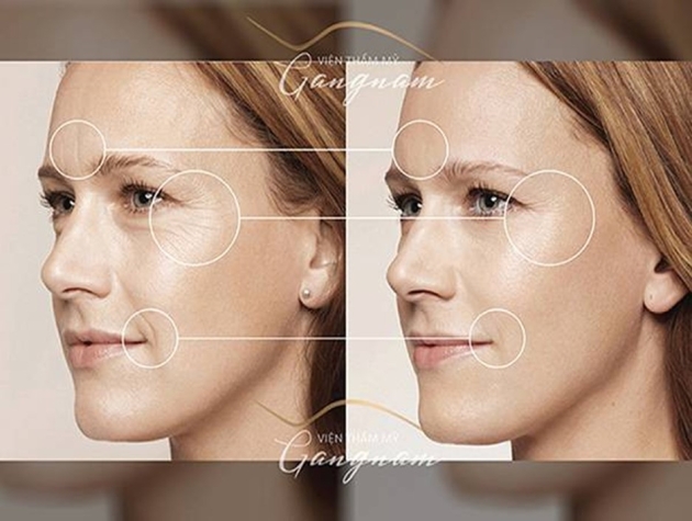 Căng da mặt bằng chỉ - Công nghệ tiên tiến giúp bạn sở hữu làn da căng mịn và tươi trẻ hơn